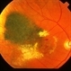 Radiation retinopathy Radiation retinopathy